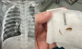 Ребёнка в Актау лечили от астмы из-за скорлупы семечек в легких