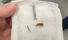 11 айлық сәбидің өкпесінен металл табылды