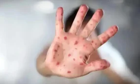 Алматыдағы қызылшамен ауырғандардың басым бөлігі — екпе алмаған балалар