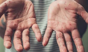 Алматыда 400-ден астам бала қызылша жұқтырған