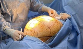 Женщина лечилась БАДами — в итоге опухоль выросла до 55 см: её спасли врачи Алматы