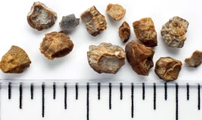 Обильное питье не спасает от образования камней в почках, - исследование