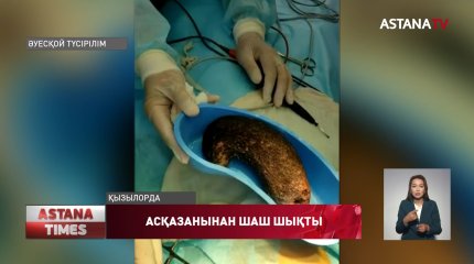Қызылордада 4 жастағы қыздың асқазанынан жарты келі шаш шықты