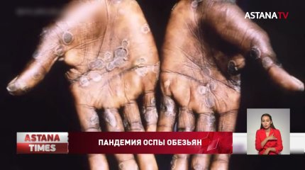 Вспышка оспы обезьян объявлена пандемией