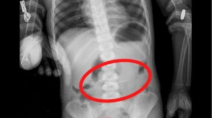 Үш жастағы бала бірнеше инені жұтып қойған