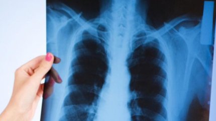 Туберкулезом стали чаще заражаться шымкентские школьники