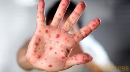 Жетісу облысында екпеден бас тартқан балалар жаппай қызылша жұқтырып жатыр