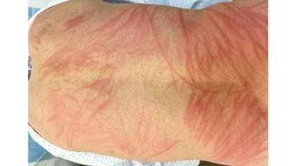 Двухнедельный жуткий зуд после ужина грибами возник у пенсионера