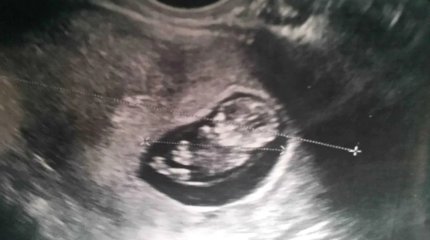 У женщины развилась беременность в печени: её едва спасли