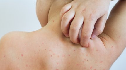 Ребёнок из Казахстана завёз корь в Южную Корею, - СМИ