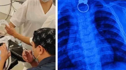 Сәби сақина жұтып қойды