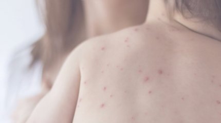 Вспышка кори в Казахстане: Минздрав опубликовал рекомендации