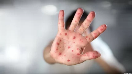 Былтыр әлемде 136 мың бала қызылшадан қайтыс болған