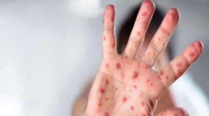 Школьник умер от кори в Азербайджане