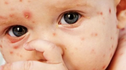 Корь затронула все регионы Казахстана, в Правительстве обеспокоены