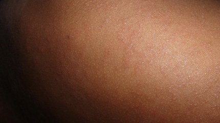 13 тысяч казахстанцев заразились корью: Гиният бьет тревогу