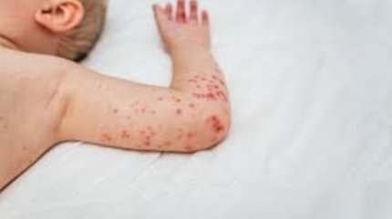 Догоним Индию? 2,5 тысячи казахстанцев заразились корью за последнюю неделю