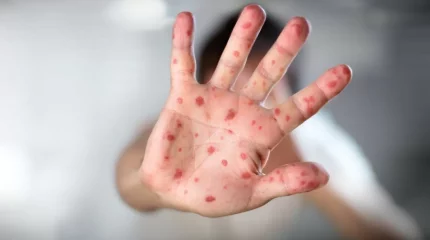 Казахстан попал в список стран с самой высокой заболеваемостью корью