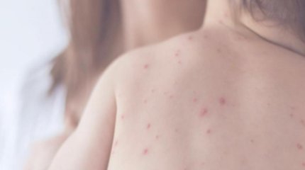 Двое детей умерли от кори в Казахстане