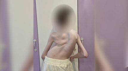 Алматыда омыртқасы 140 градусқа қисайған балаға күрделі операция жасалды