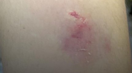 Собака укусила школьника во время физкультуры в Актау