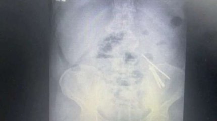 10-сантиметровые гвозди извлекли из кишечника жителя Алматинской области