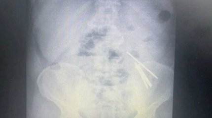 Алматы облысында ер адам өз-өзіне қол жұмсамақ болып, екі рет шеге жұтқан