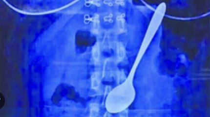 Алматинец проглотил столовую ложку