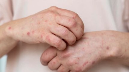 Эпидситуация по кори осложнилась в Астане