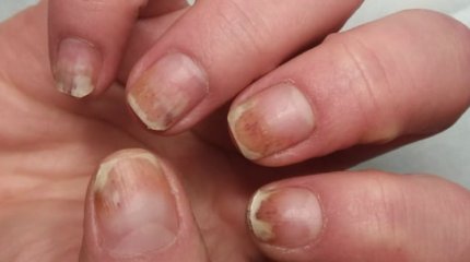 Жительница Уральска не смогла доказать в суде ожог ногтевой пластины из-за маникюра