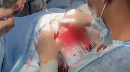 Шымкентте 10 жасар баланың миынан бір уыс құрт алынды