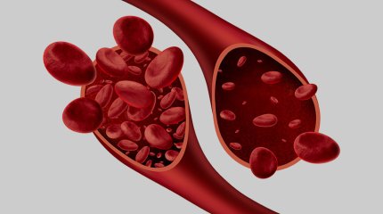 ДДҰ анемиямен күрес бағдарламасын жасап шықты