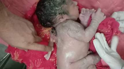 Ребенок с тремя руками родился в Индии