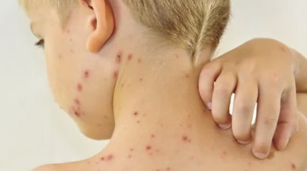 Вспышка кори у детей наблюдается в Алматы