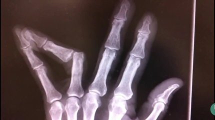 Девочке оторвало палец в частном садике Атырау