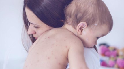 Семилетний ребёнок из ВКО заразился корью в Турции