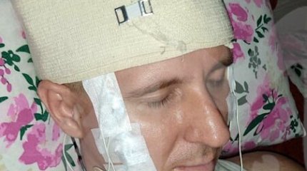 Мужчина просверлил себе голову, чтобы вставить чип для сновидений