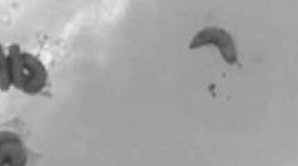 Живых червей извлекли из носа карагандинки