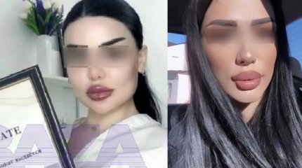 Девушка умерла во время операции по увеличению ягодиц