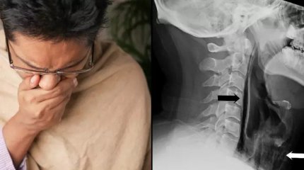 Мужчина сдержал чих и попал в больницу с травмой горла