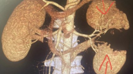 Россиянин лишился почки после падения с самоката