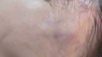 Ребёнок вернулся из детского сада в Павлодаре с гематомами