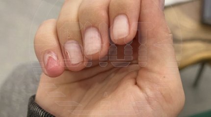 Гель-лак разъел ногтевые пластины девушки