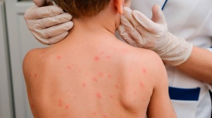 Елімізде қызылша ауруы дендеп барады