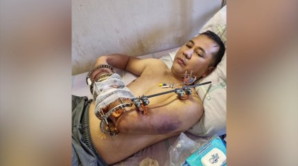 Алматыда өндіріс орнында жарақат алған жұмысшы қолынан айырылды