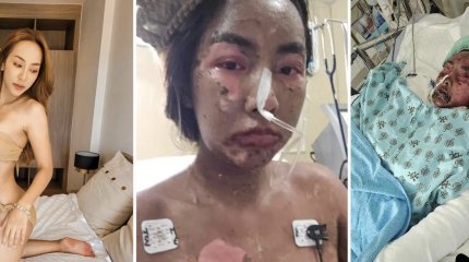 Блогер потеряла зрение и половину кожи, а затем впала в кому из-за антибиотика