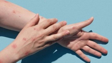 Германияда маймыл шешегі алғаш рет анықталды