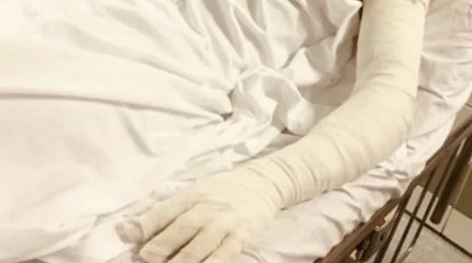 При взрыве газа четыре кызылординских подростка получили 90% ожогов