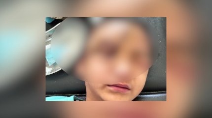 "Внучка еще не видела, как выглядит": пластического хирурга ищут для пострадавшей 12-тилетней девочки в Актау