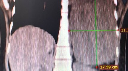 Алматинке удалили гигантскую опухоль диафрагмы